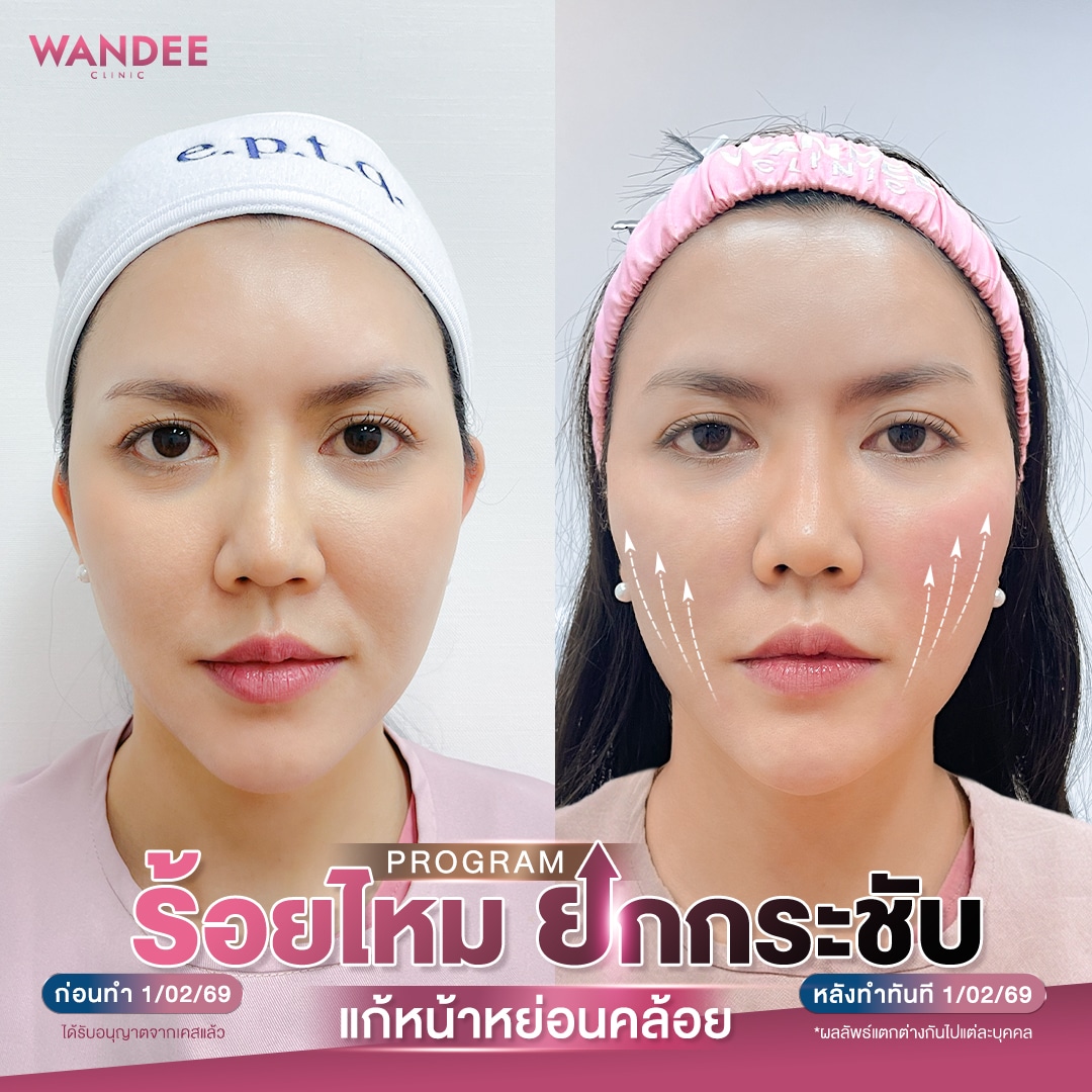 ร้อยไหมยกกระชับ