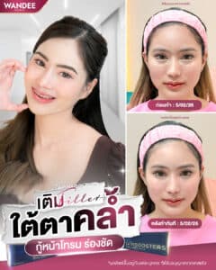 ใต้ตาคล้ำ