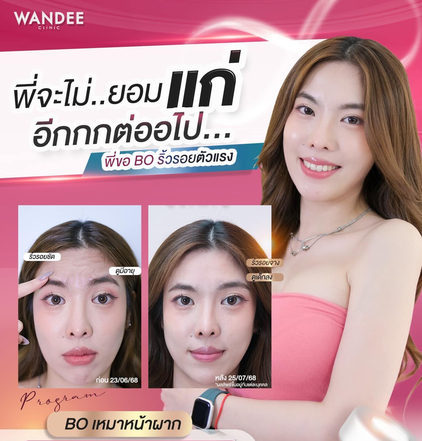 โบท็อกซ์