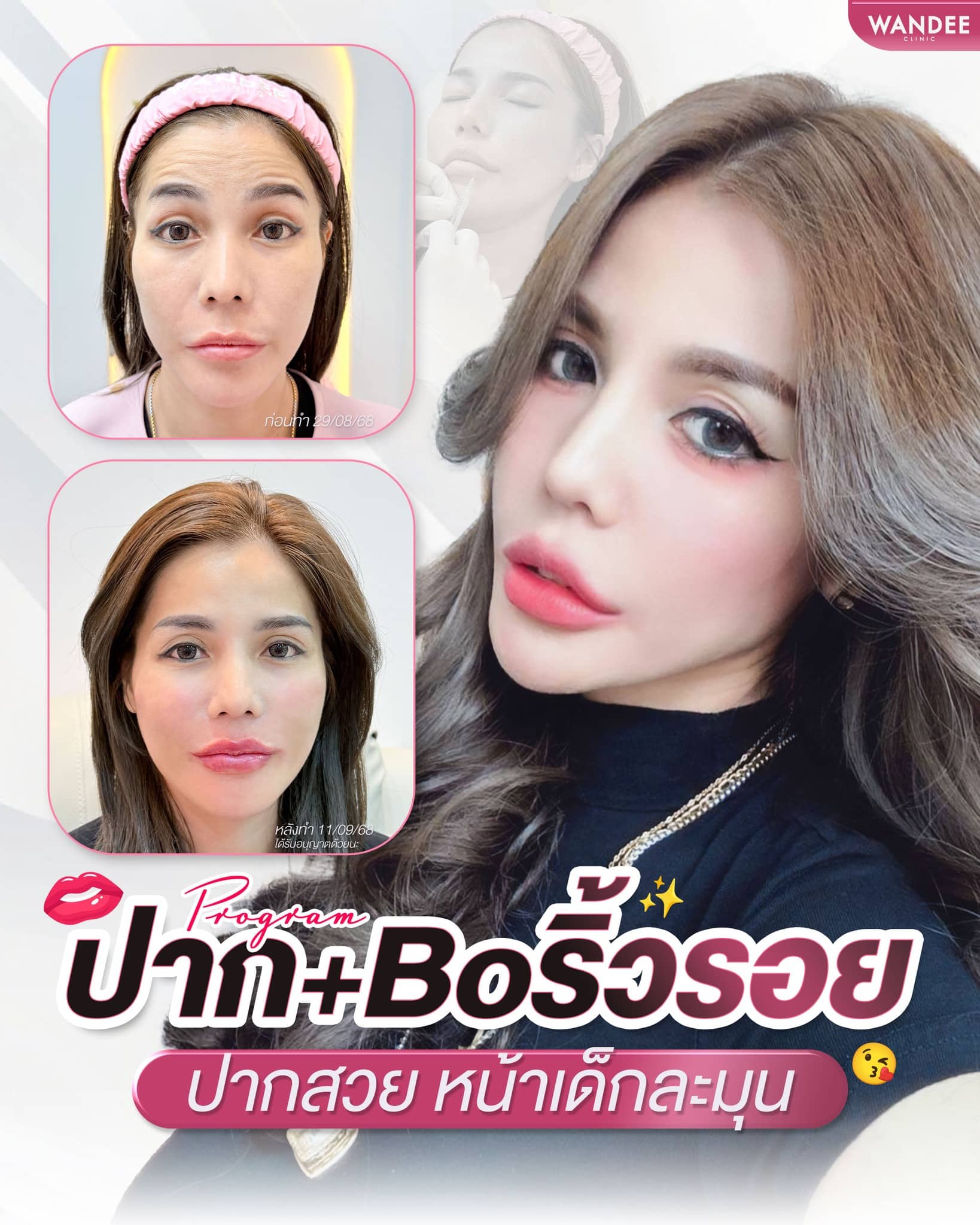 โบท็อกซ์และฟิลเลอร์