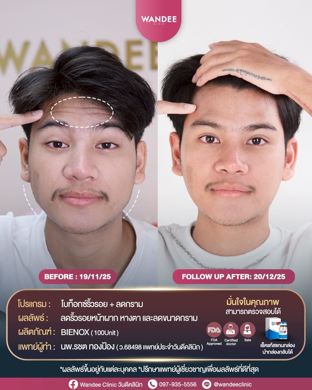 โบท็อกซ์