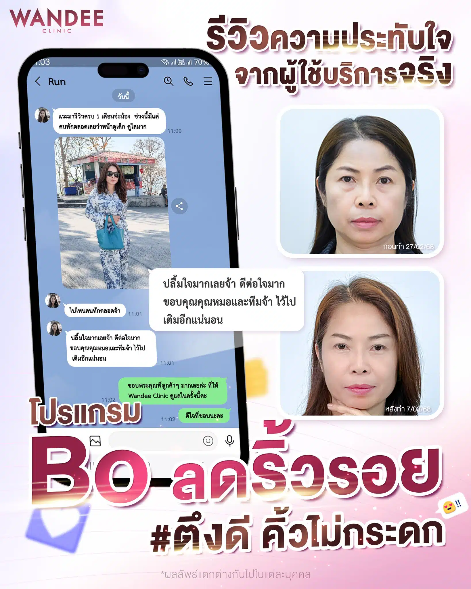 รีวิวจากผู้ใช้บริการ ฉีดโบท็อกที่วันดีคลินิก