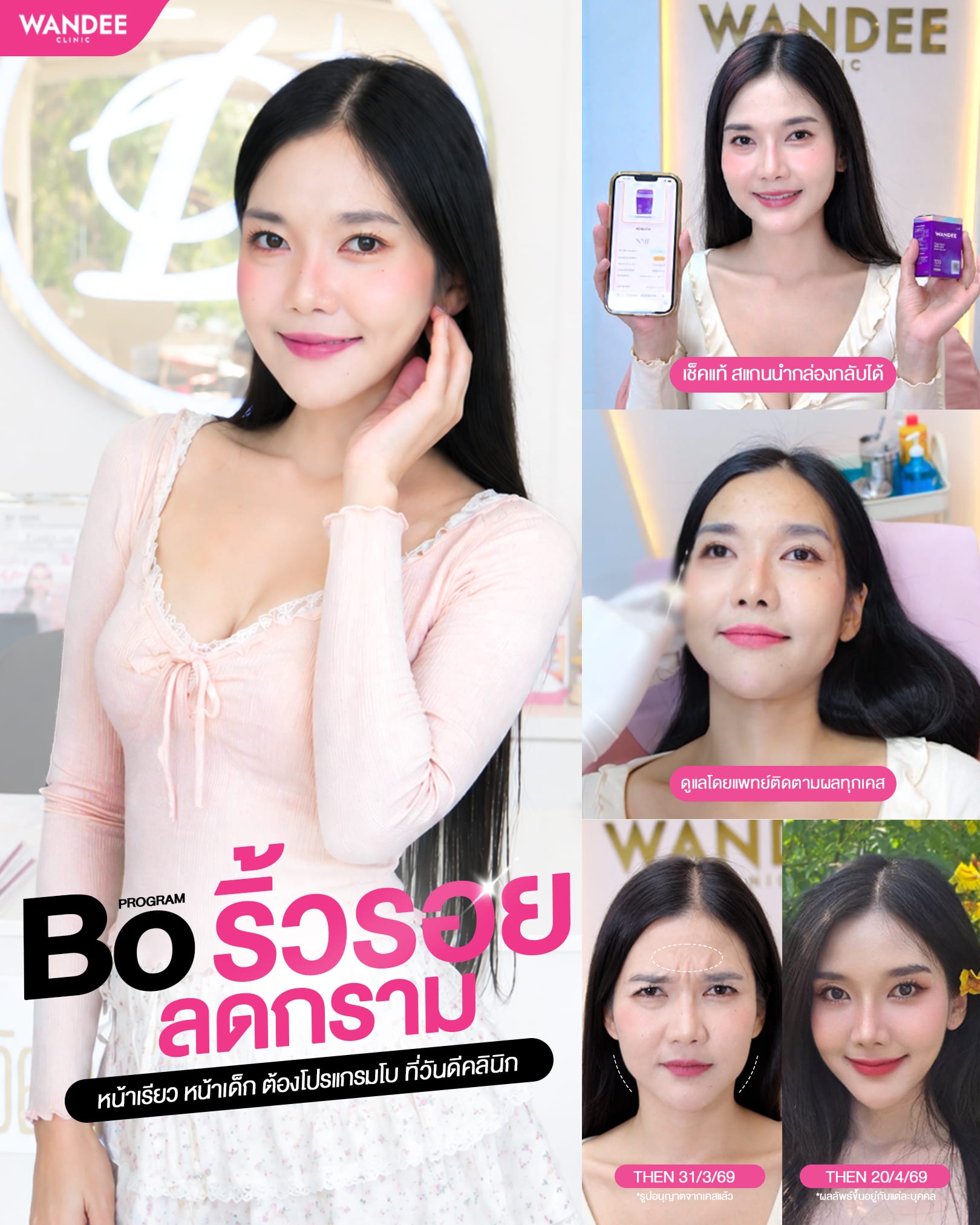 𝗣𝗿𝗼𝗴𝗿𝗮𝗺 𝗕𝗼 ลดริ้วรอยตื้นทั่วใบหน้า + ลดกล้ามเนื้อกราม