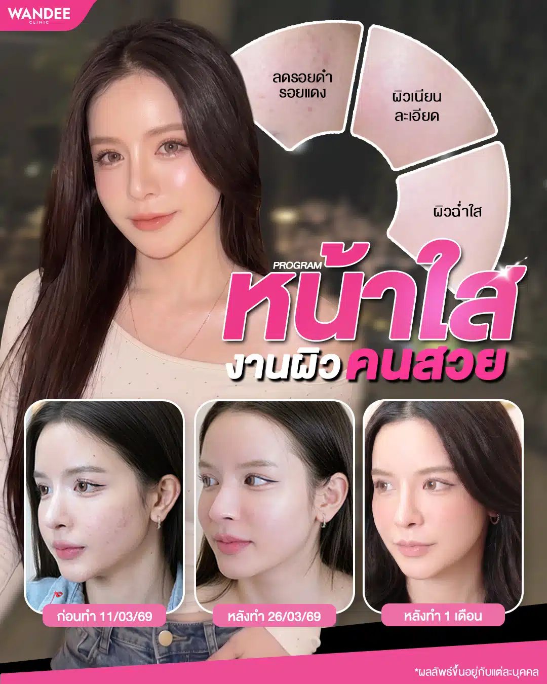 งานผิวคนสวย ต้องนี่เลย 💕 𝗣𝗿𝗼𝗴𝗿𝗮𝗺 หน้าใส ช่วยลดรอยดำ
