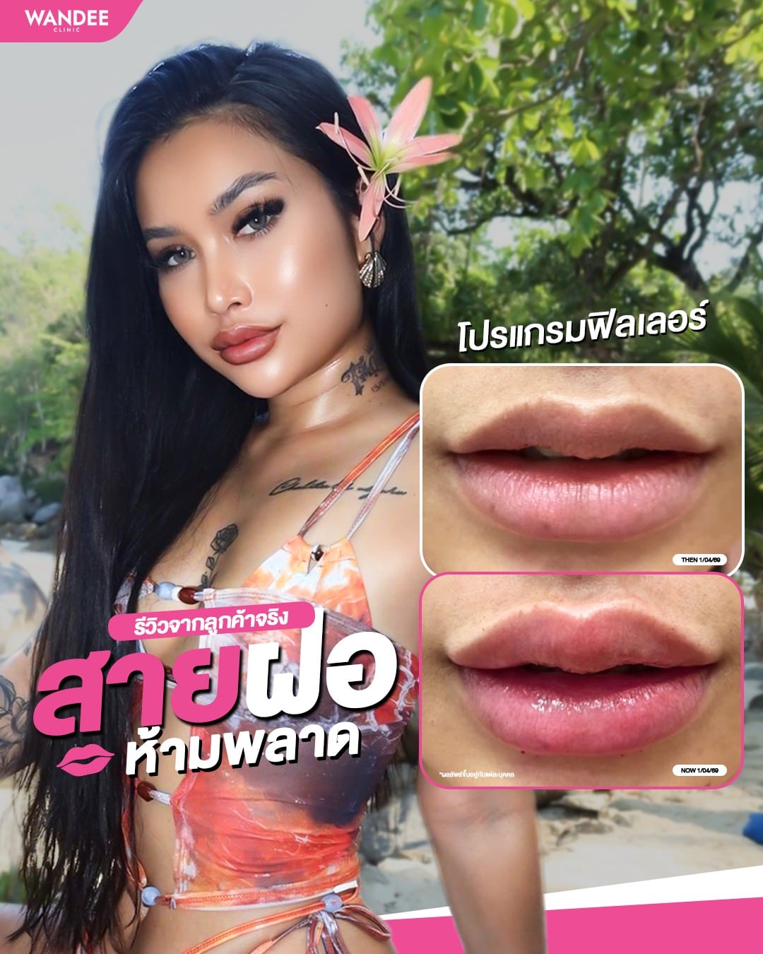 ปากสวยตรงเรฟ ที่ 𝗪𝗮𝗻𝗱𝗲𝗲 𝗖𝗹𝗶𝗻𝗶𝗰 ✨ เติมนิดเดียว หน้าดูละมุน มีมิติขึ้น