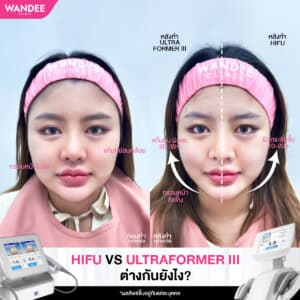 ยกกระชับเหมือนกัน