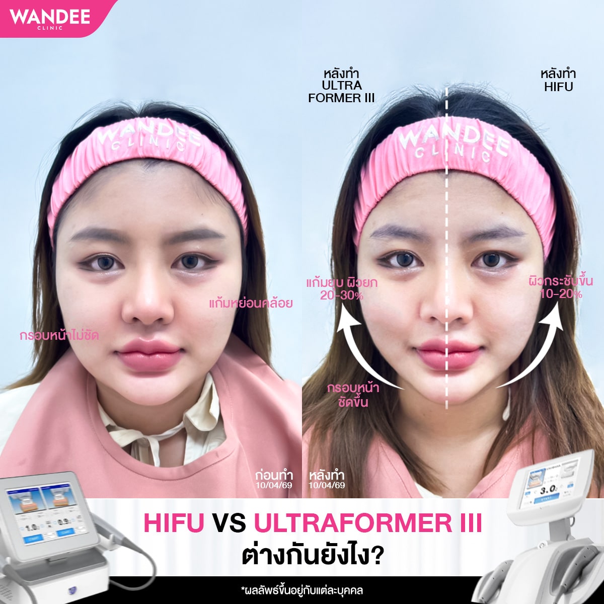 ยกกระชับเหมือนกัน