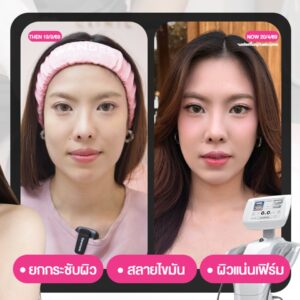 𝗨𝗹𝘁𝗿𝗮𝗳𝗼𝗿𝗺𝗲𝗿 𝗜𝗜𝗜 ช่วยยกกระชับ