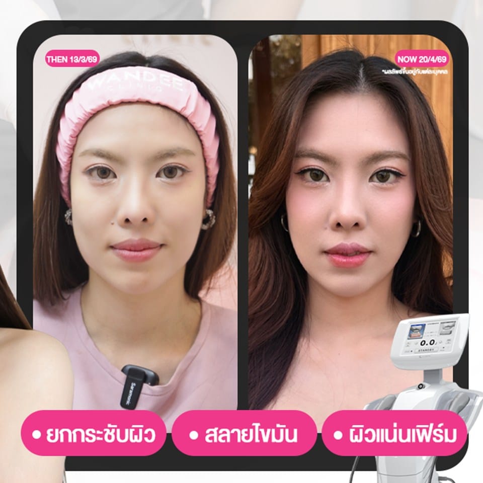 𝗨𝗹𝘁𝗿𝗮𝗳𝗼𝗿𝗺𝗲𝗿 𝗜𝗜𝗜 ช่วยยกกระชับ