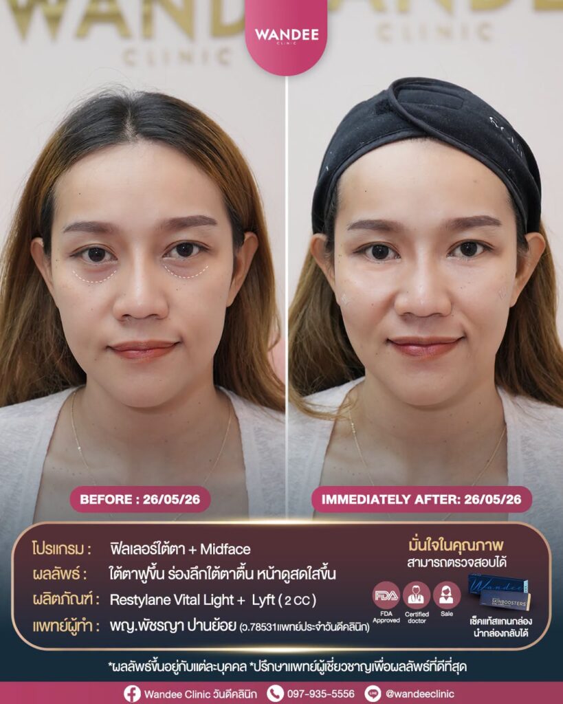 ใต้ตาคล้ำ ร่องลึก