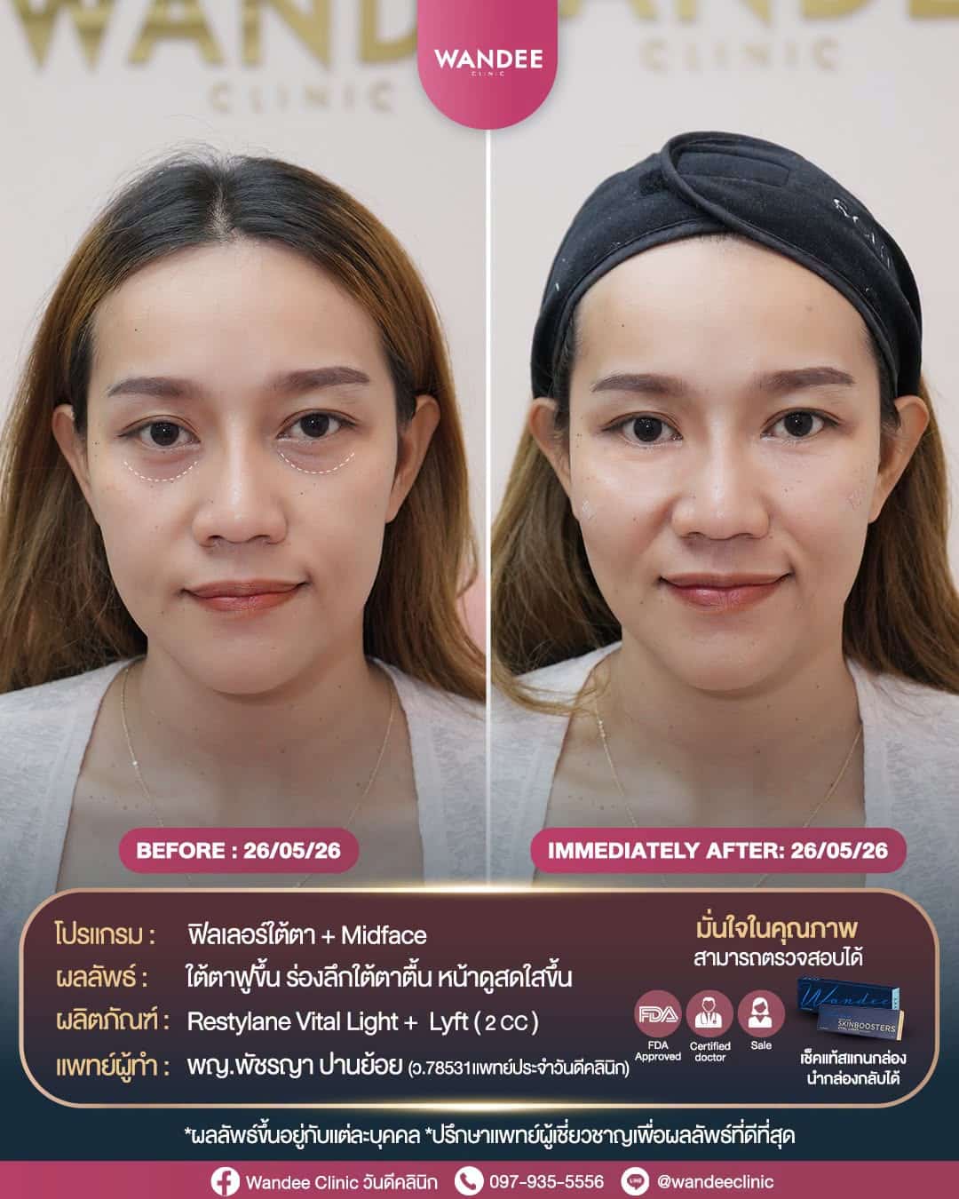 ใต้ตาคล้ำ ร่องลึก