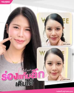 ร่องแก้มลึก หน้าแก่กว่าวัย