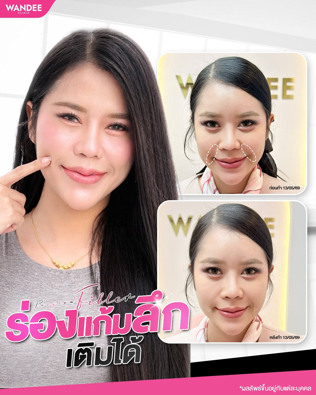 ร่องแก้มลึก หน้าแก่กว่าวัย