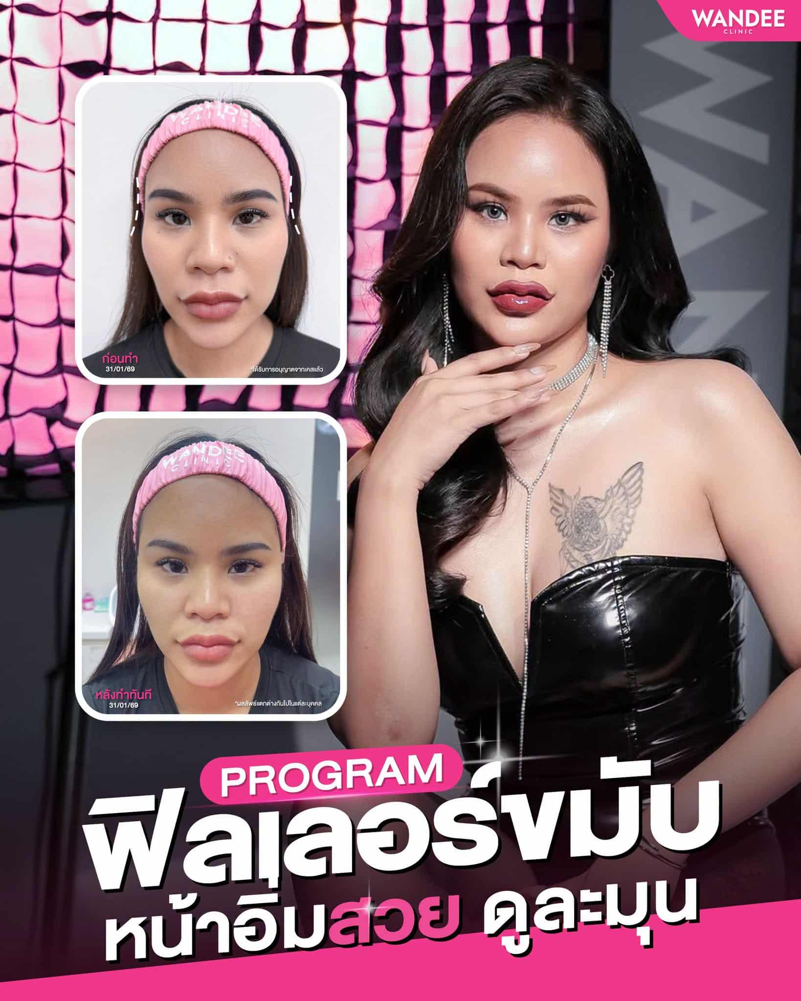 หน้าอิ่มสวย ละมุนขึ้นทั้งหน้า