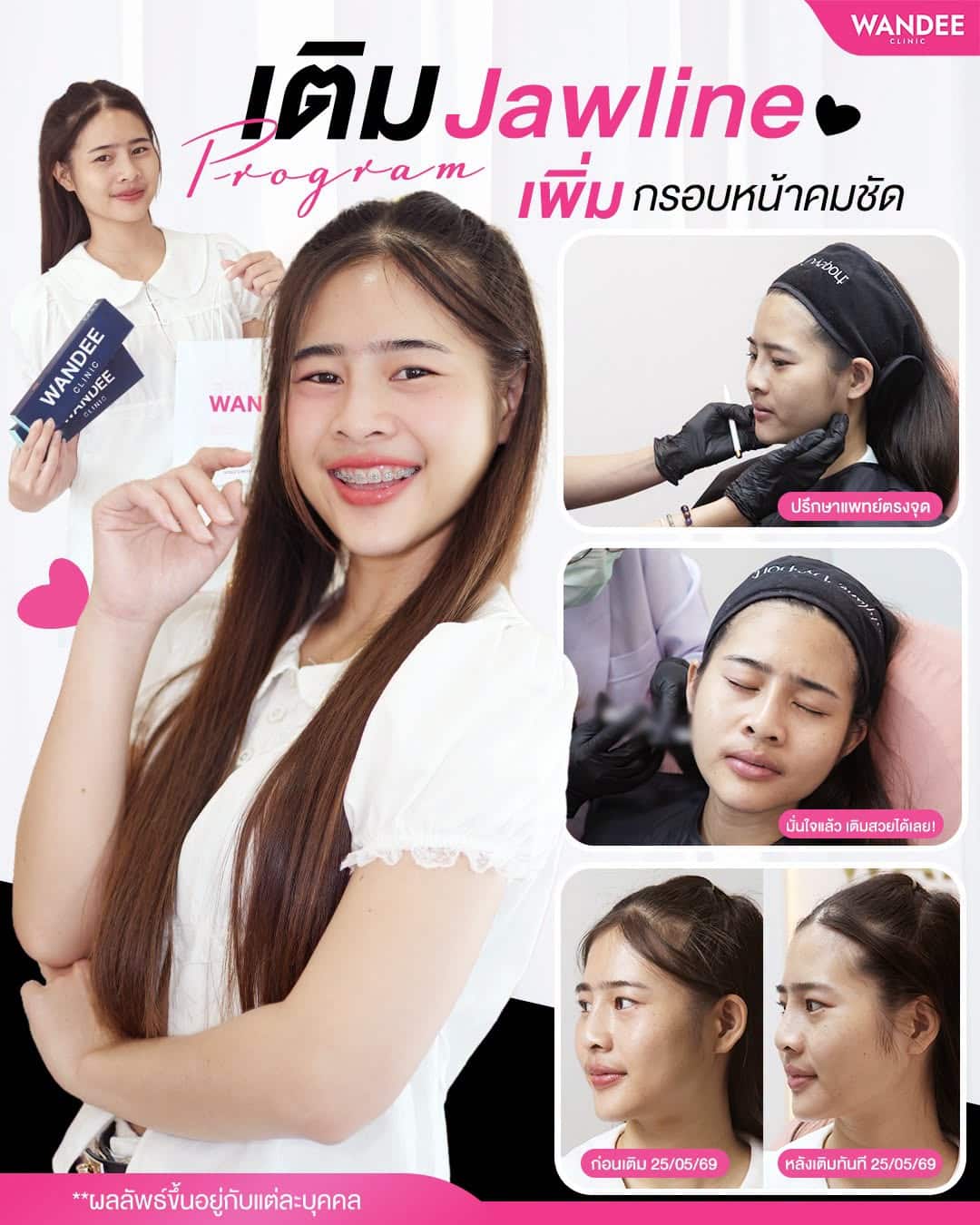 หน้าเป๊ะขึ้น ไม่ต้องพึ่งมุมกล้อง