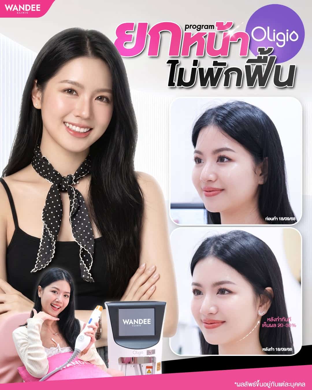 แก้มเหนียงลด หน้ายก กรอบชัดขึ้น!