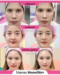 ใต้ตาคล้ำ ร่องลึก หน้าโทรม ดูเหนื่อย