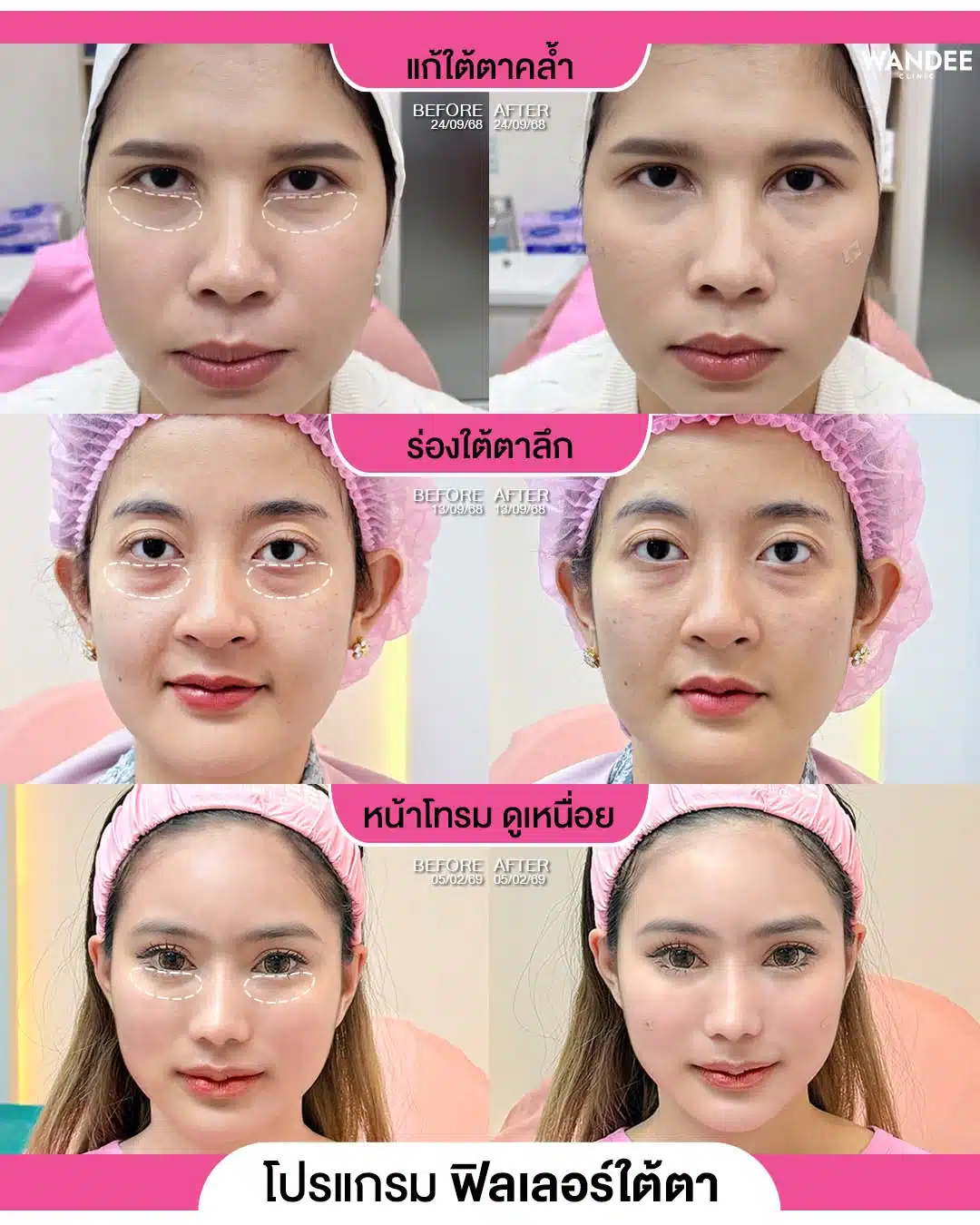 ใต้ตาคล้ำ ร่องลึก หน้าโทรม ดูเหนื่อย