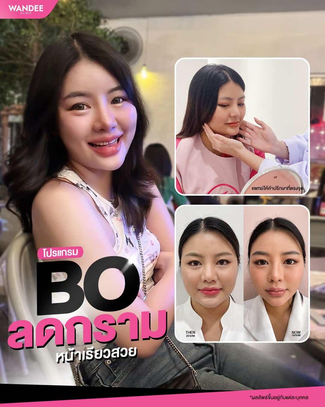 กรามใหญ่ ไม่มั่นใจ ขอเป็นหน้าเรียวสวยได้มั้ยคะ!🥺 จัดนี่เลย 𝗣𝗿𝗼𝗴𝗿𝗮𝗺 𝗕𝗼
