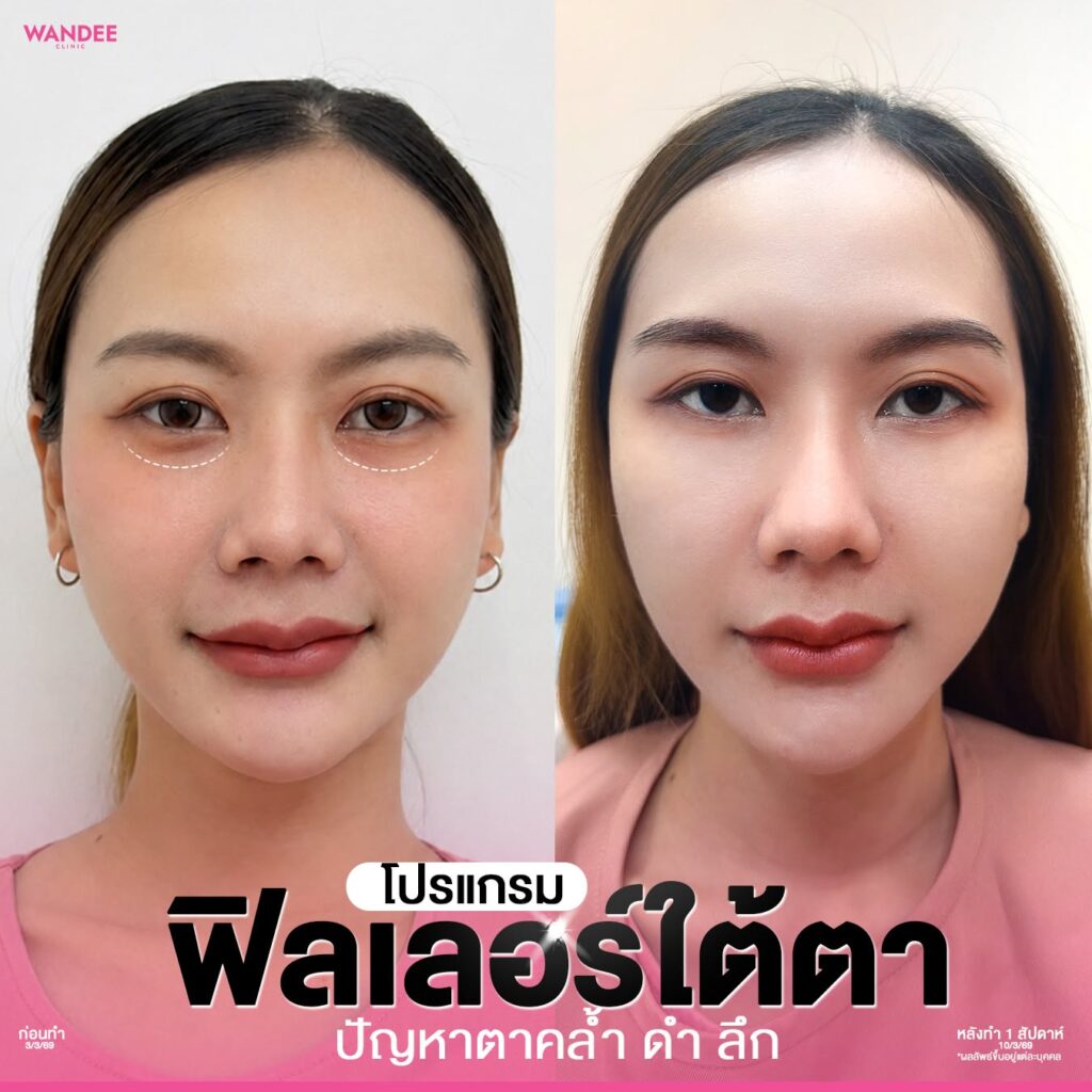 บอกลาใต้ตาคล้ำ ดำ ลึก ดูโทรม❗ ด้วย 𝗣𝗿𝗼𝗴𝗿𝗮𝗺 𝗙𝗶𝗹𝗹𝗲𝗿 ใต้ตา คืนความอิ่มฟู