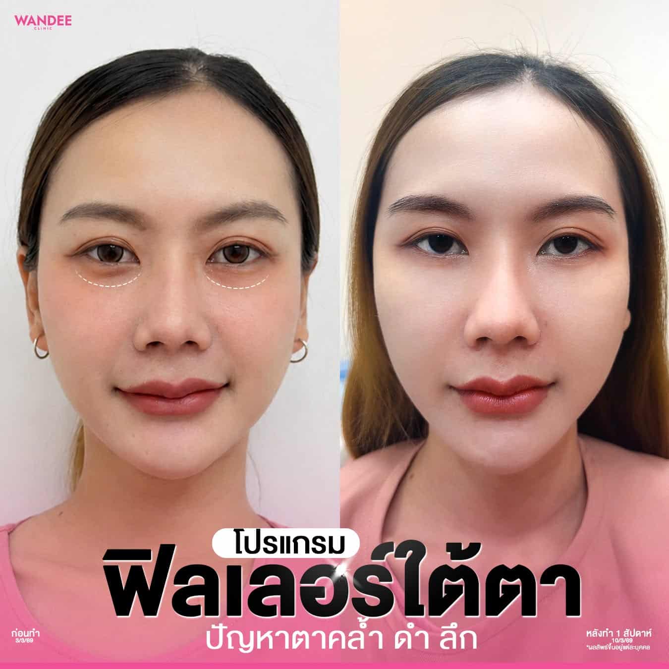 บอกลาใต้ตาคล้ำ ดำ ลึก ดูโทรม❗ ด้วย 𝗣𝗿𝗼𝗴𝗿𝗮𝗺 𝗙𝗶𝗹𝗹𝗲𝗿 ใต้ตา คืนความอิ่มฟู